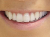 AFTER Invisalign treatment 