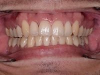 AFTER Invisalign treatment 