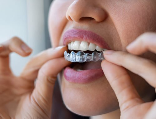 How Does Invisalign Move Teeth? All You Need To Know