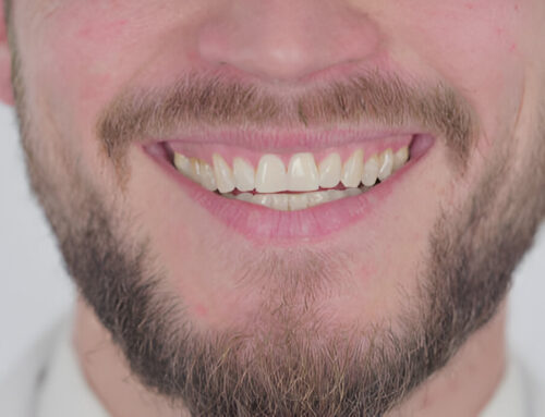 Can Composite Bonding Fix Crooked Teeth? All You Need To Know