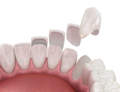 How Long Do Composite Veneers Last?