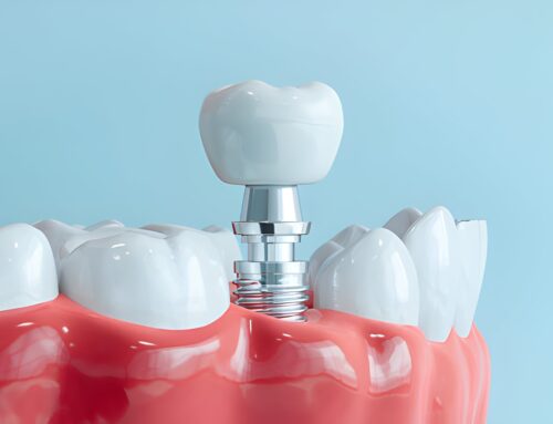 How Long Does The Dental Implant Process Take in Broxburn?