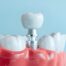 Dental Implant Process