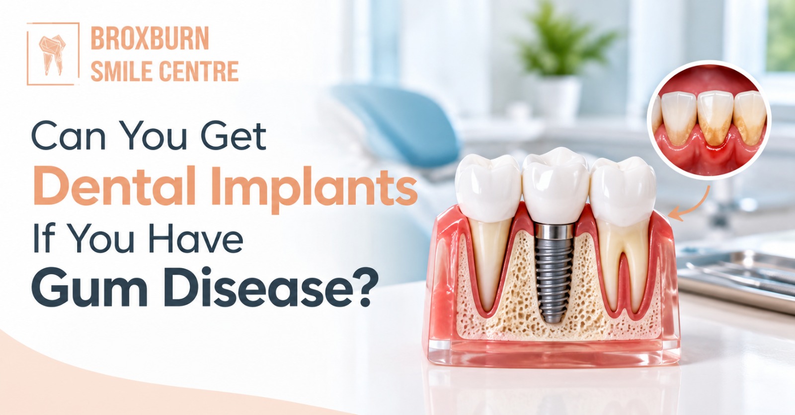 Dental Implant