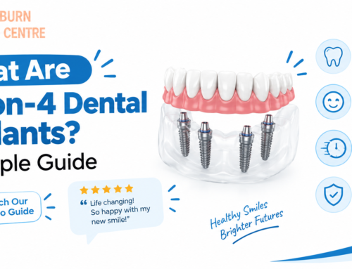What Are All-on-4 Dental Implants? A Simple Guide